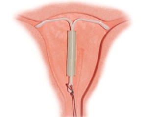 IUD